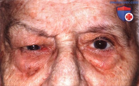Вторичные опухоли глазницы