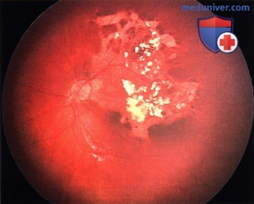 Примеры хеморедукции ретинобластомы