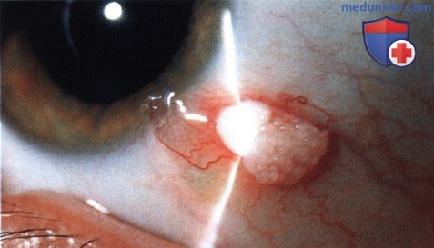 Хористома конъюнктивы из тканей слезной железы и респираторного эпителия