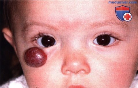 Врожденная капиллярная гемангиома (земляничная гемангиома) века глаза