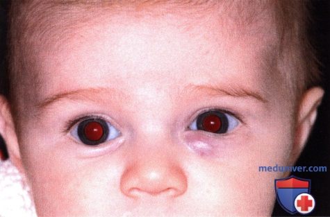 Врожденная капиллярная гемангиома (земляничная гемангиома) века глаза