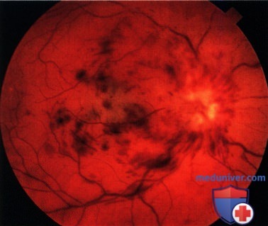 Злокачественная астроцитома зрительного нерва