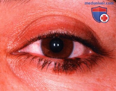 Злокачественное лентиго (меланотическая веснушка Hutchinson) века глаза