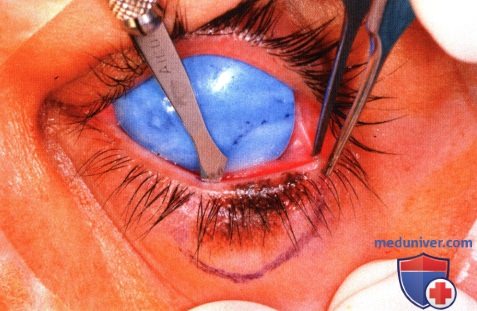 Злокачественное лентиго (меланотическая веснушка Hutchinson) века глаза