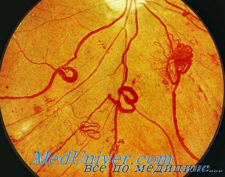 Глазное дно при диабетической ретинопатии