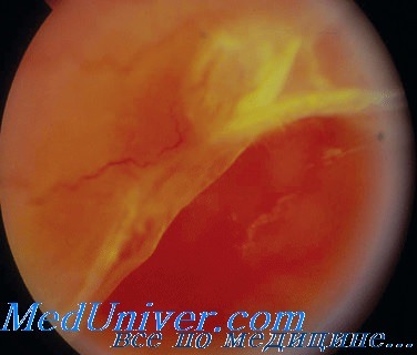 глаукома при диабетической отслойке сетчатки