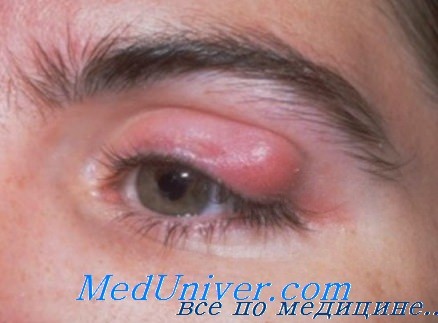 инфекционные поражения глаз
