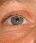 осложнения травм глаза