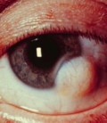 глаза при инфекциях