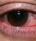 инфекции глаз