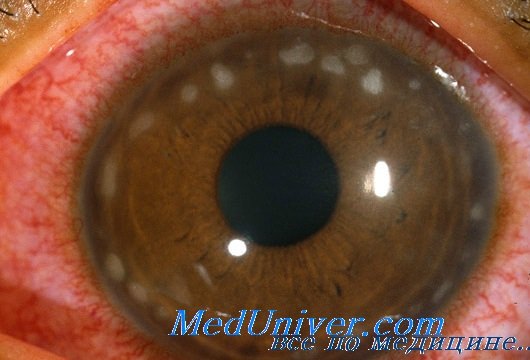 глаза при цитомегаловирусной инфекции
