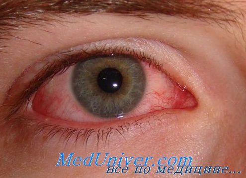 Постоянно воспаляются глаза после операции. Из-за чего может произойти воспаление глаза. Данная операция показана людям в таких случаях