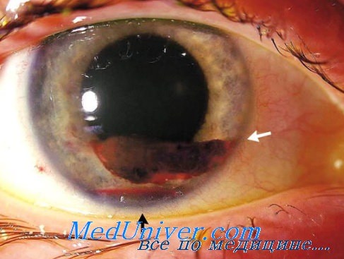 инфекции глаз после операции
