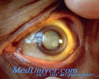 иммуннитет и инфекция глаза