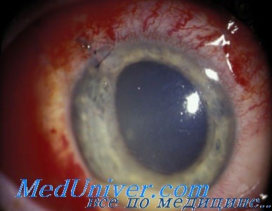 инфекция глаза при эндофтальмите