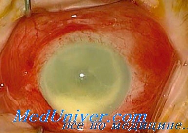 эндофтальмит после ранений глаза
