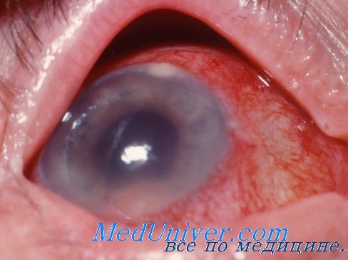 проникновение антибиотиков в жидкости глаза