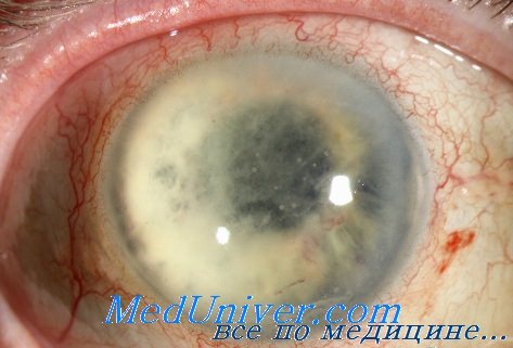 лечение инфекции глаз гентамицином