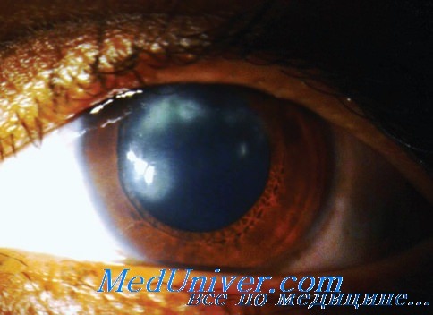 глаза при гиперпаратиреозе