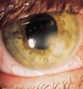 глаза при онхоцеркозе