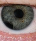 глаза при гельминтозах