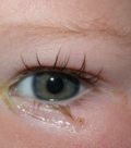 заболевания глаз у детей