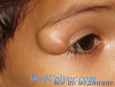 дермоид глаз детей