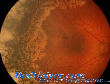 ретинопатия недоношенных