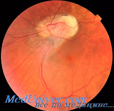 ретинопатии у детей