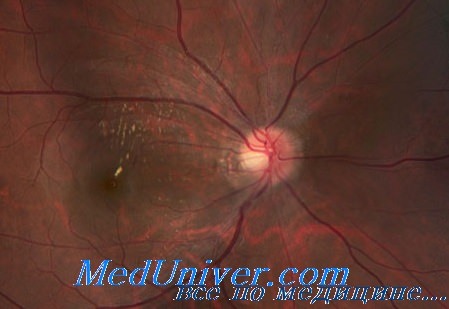 ретинопатии у детей