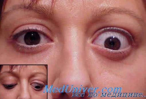 Эндокринная миопатия глаз лечение thumbnail