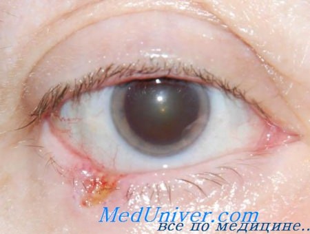 Симптомы рака глаз