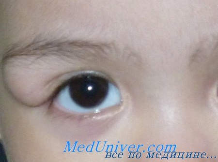 Киста конъюнктивы глаза и её лечение