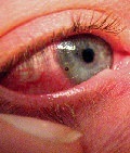травмы глазницы