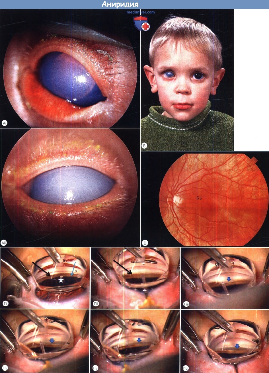 Пересадка роговицы глаз ребенку thumbnail