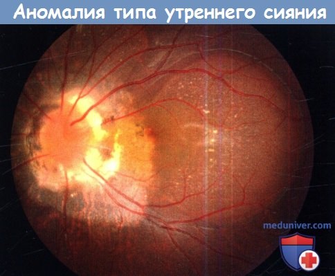 Аномалия типа утреннего сияния при атрофии зрительного нерва