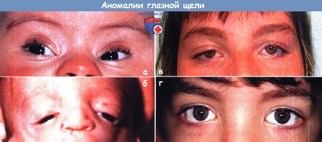 Аномалии глазной щели