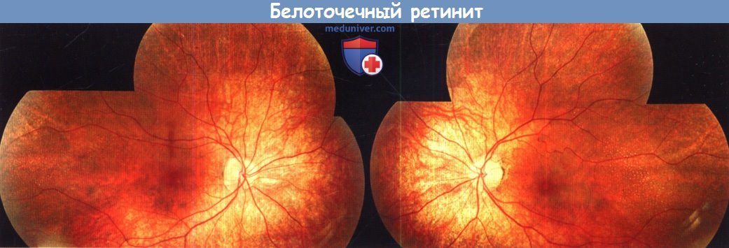 Белоточечный ретинит