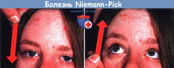  Niemann-Pick