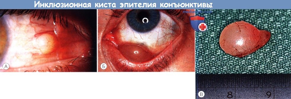 Отек глаза после операции косоглазия thumbnail