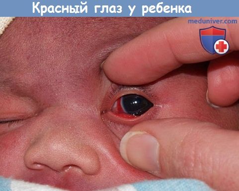 Покраснение глаз у детей: причины и лечение