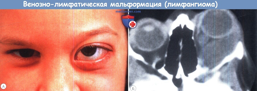 Лимфангиома орбиты глаза лечение thumbnail