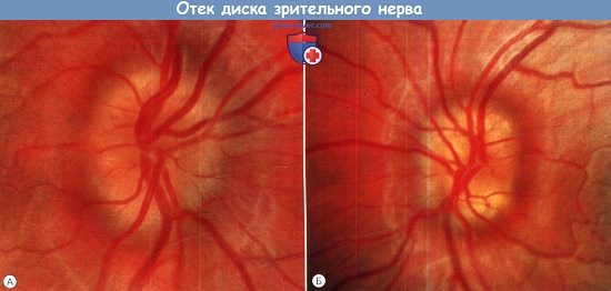 Отек диска зрительного нерва