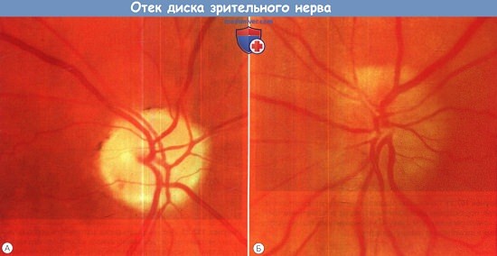 Отек диска зрительного нерва