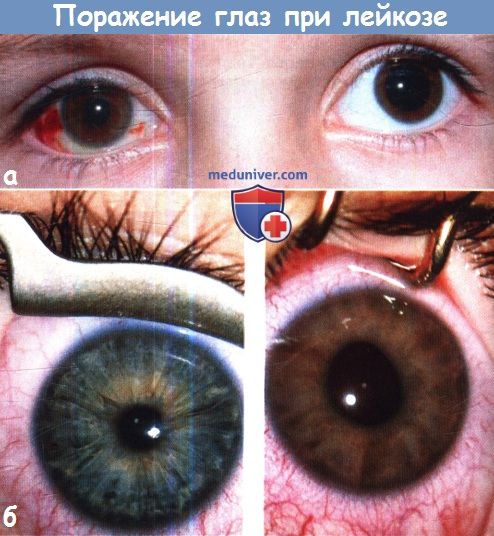 Поражение глаз при лейкозе