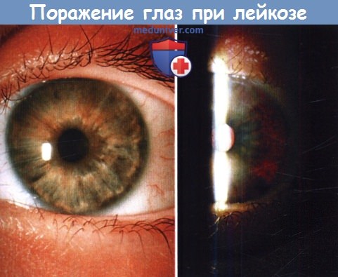 Поражение глаз при лейкозе