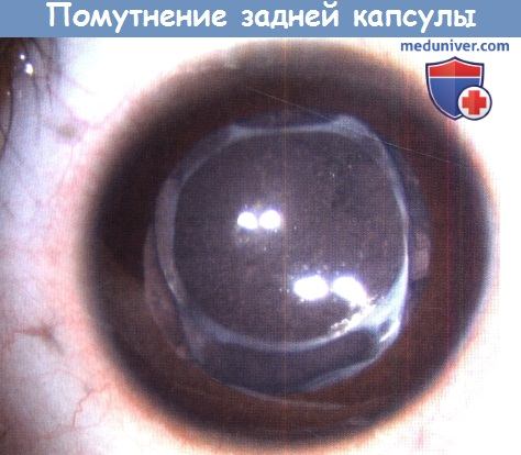 Помутнение задней капсулы хрусталика после операции на катаракте