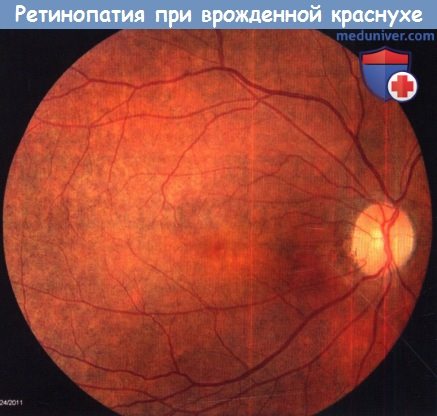Для синдрома врожденной краснухи характерно поражение органа зрения в виде thumbnail