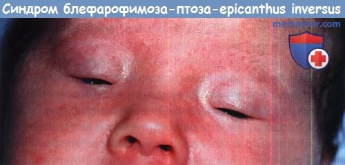 Синдром блефарофимоза-птоза-epicanthus_inversus