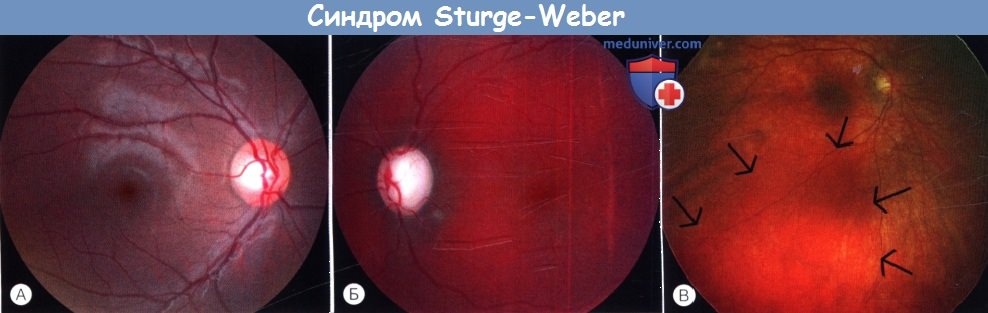     Sturge-Weber